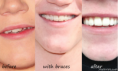 /album/photogallery/beforewithbraceaafter-png1/